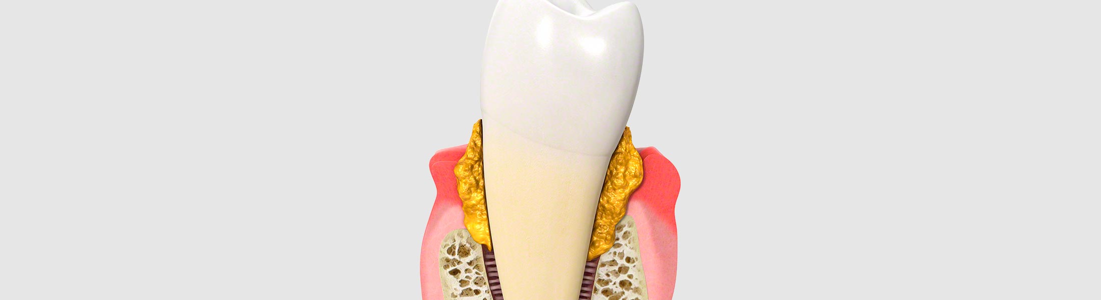 Parodontologie_gingivitis_0